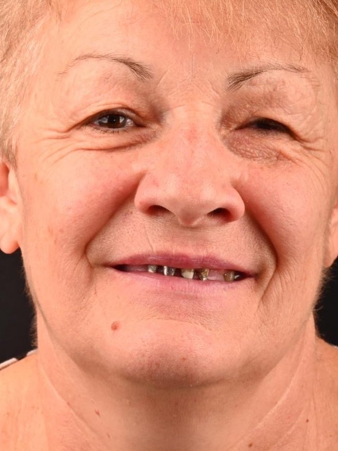 Caz reabilitare protetică Bel-Dent Baia Mare, dinți lipsă și lucrări vechi înainte de tratament