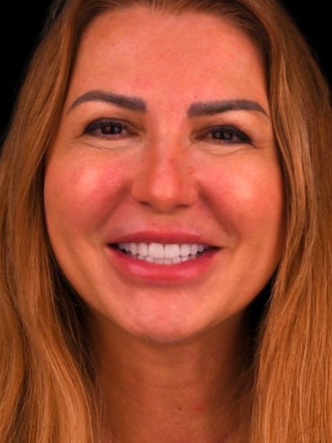 Caz reabilitare protetică Bel-Dent Baia Mare, zâmbet complet refăcut după tratament