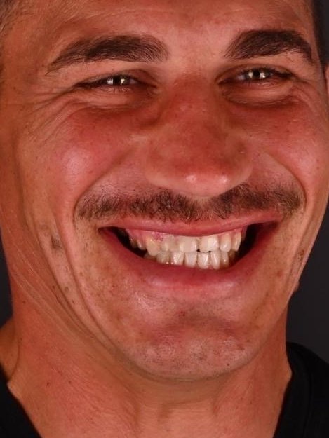 Caz fațete dentare Bel-Dent Baia Mare, dinți gălbui înainte de tratament