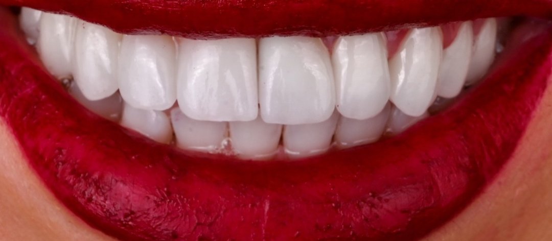 Caz reabilitare protetică Bel-Dent Baia Mare, coroane dentare după tratament
