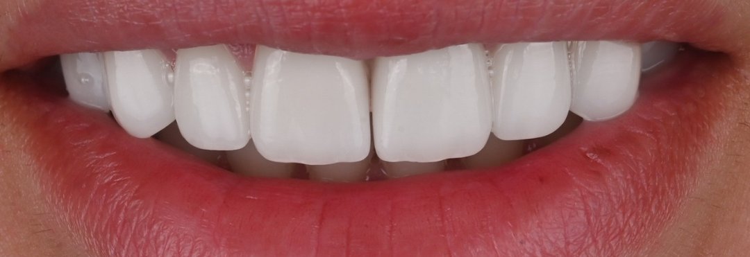Caz fațete dentare Bel-Dent Baia Mare, zâmbet natural după tratament
