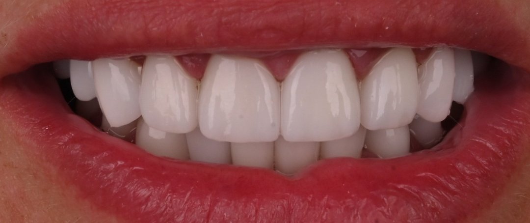 Caz coroane dentare Bel-Dent Baia Mare, zâmbet refăcut după tratament