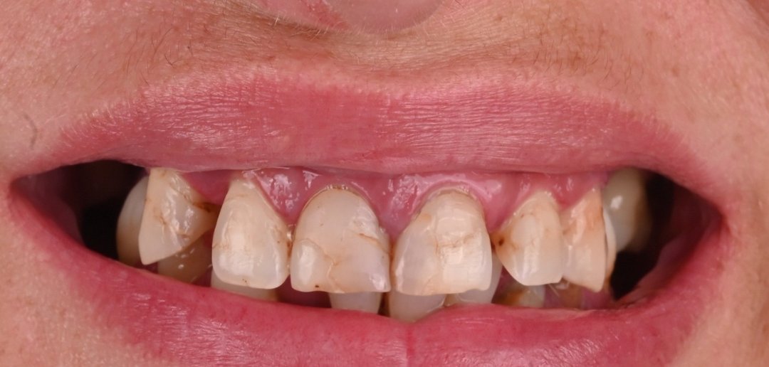 Caz coroane dentare Bel-Dent Baia Mare, dinți uzați și pătați înainte de tratament