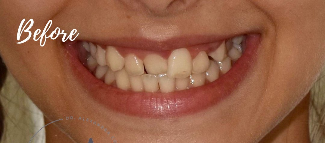 Caz ortodonție Bel-Dent Baia Mare, înghesuire dentară înainte de tratament