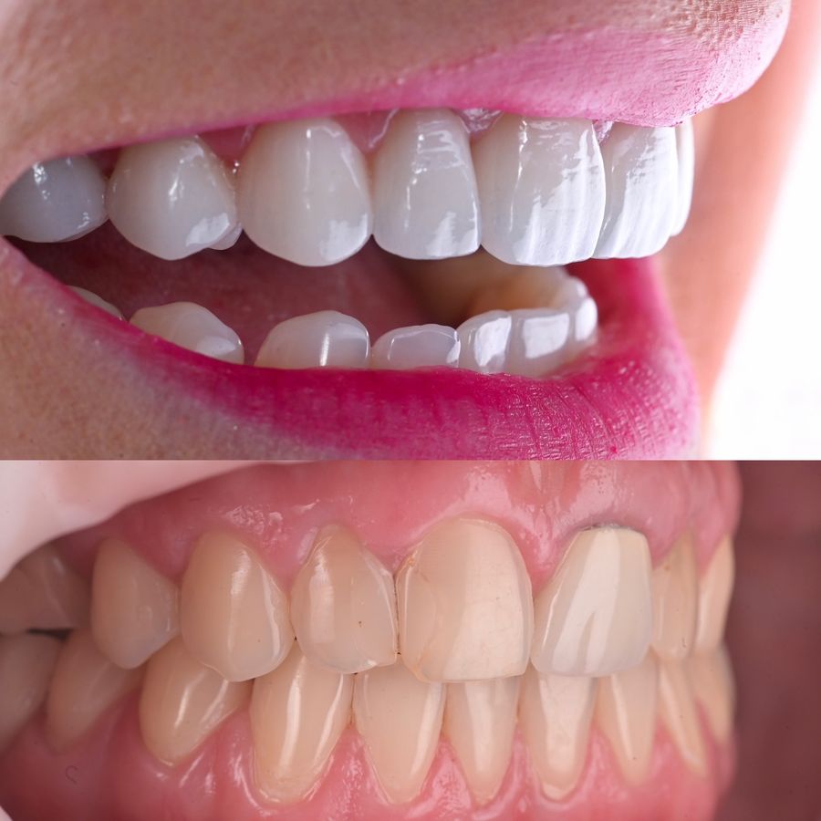 Detartraj și igienizare dentară la Bel-Dent Baia Mare