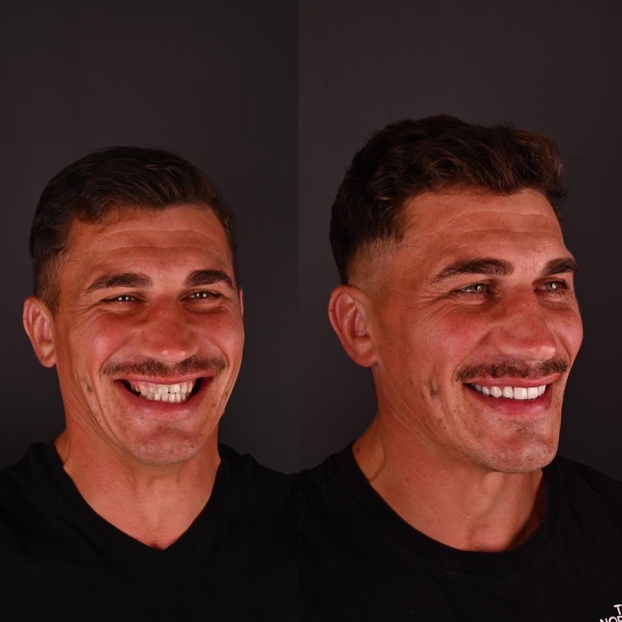 Rezultatul unui tratament cu implant dentar din portofoliul Bel-Dent Baia Mare, tipul de lucrare pentru care se alege plata în rate