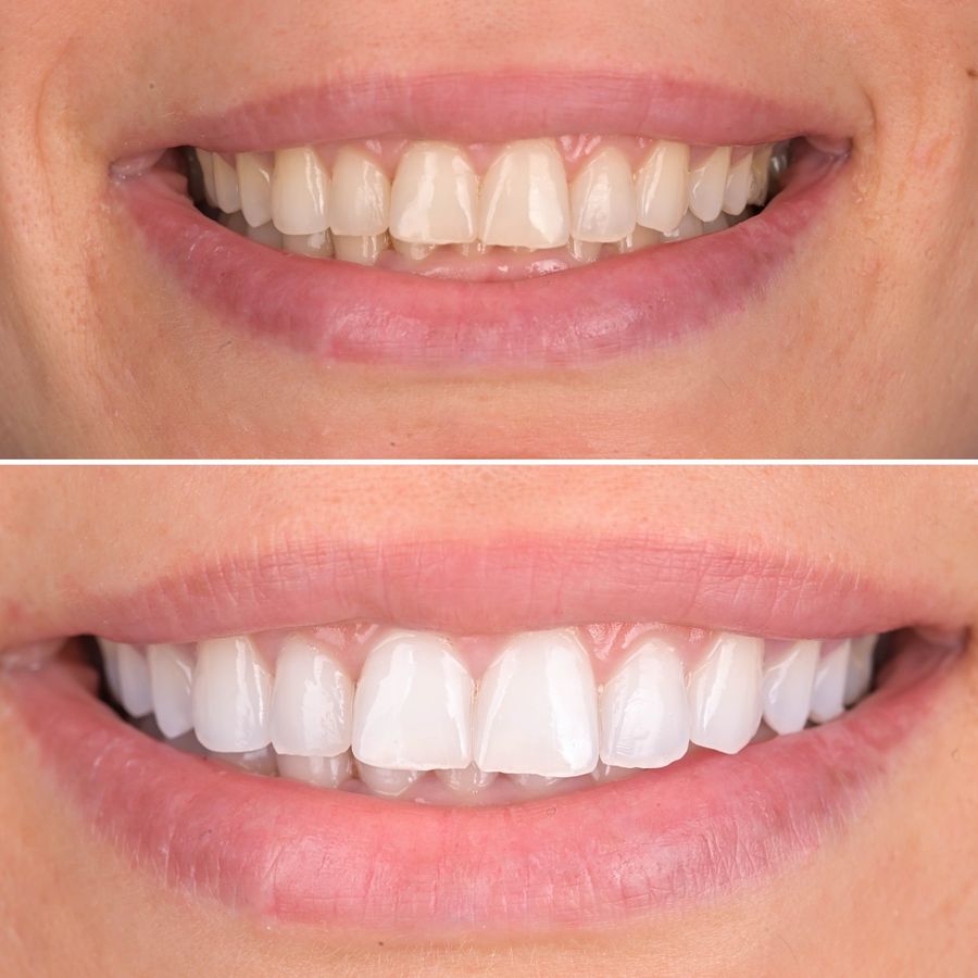 Tratament estetic dentar realizat la Bel-Dent Baia Mare
