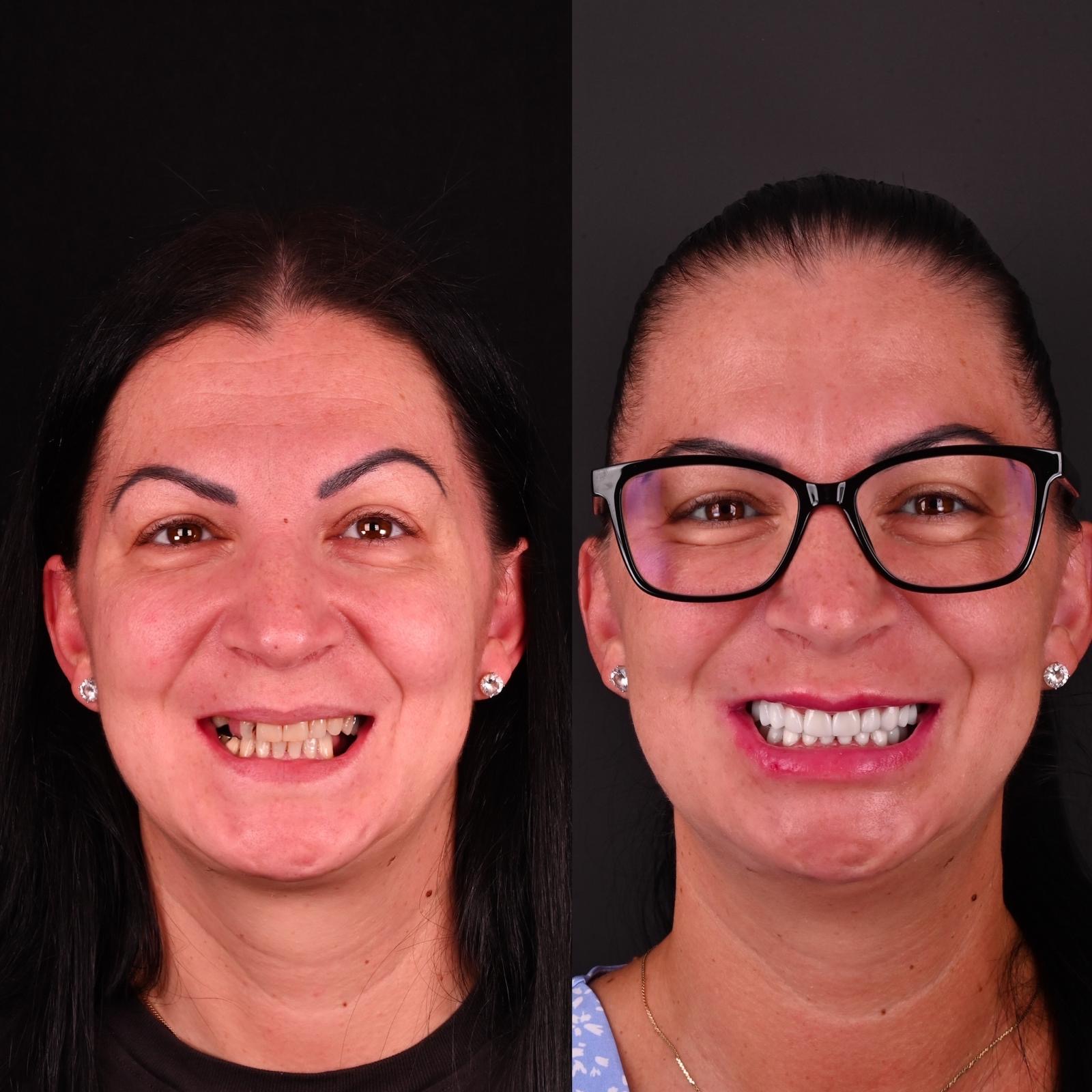 Rezultat de estetică dentară din portofoliul Bel-Dent Baia Mare